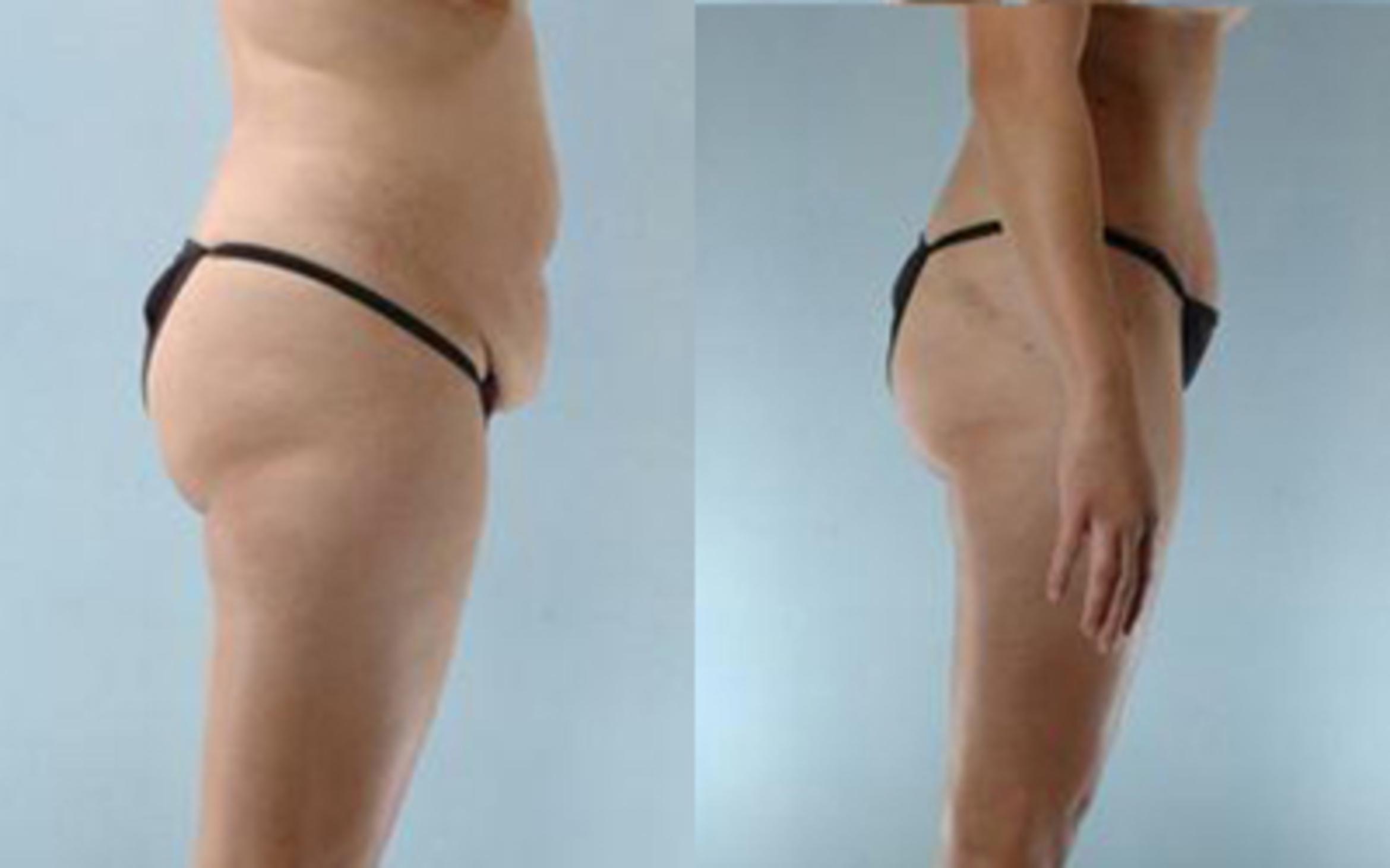 Before & After Tummy Tuck Case 7 View 3 View in Houston, TX