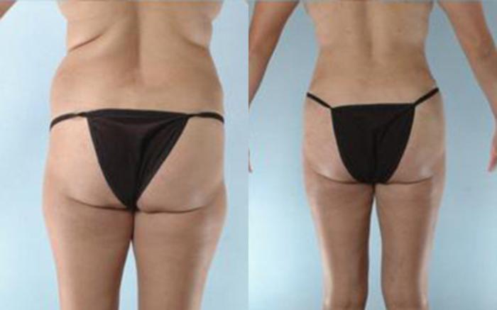 Before & After Tummy Tuck Case 7 View 4 View in Houston, TX