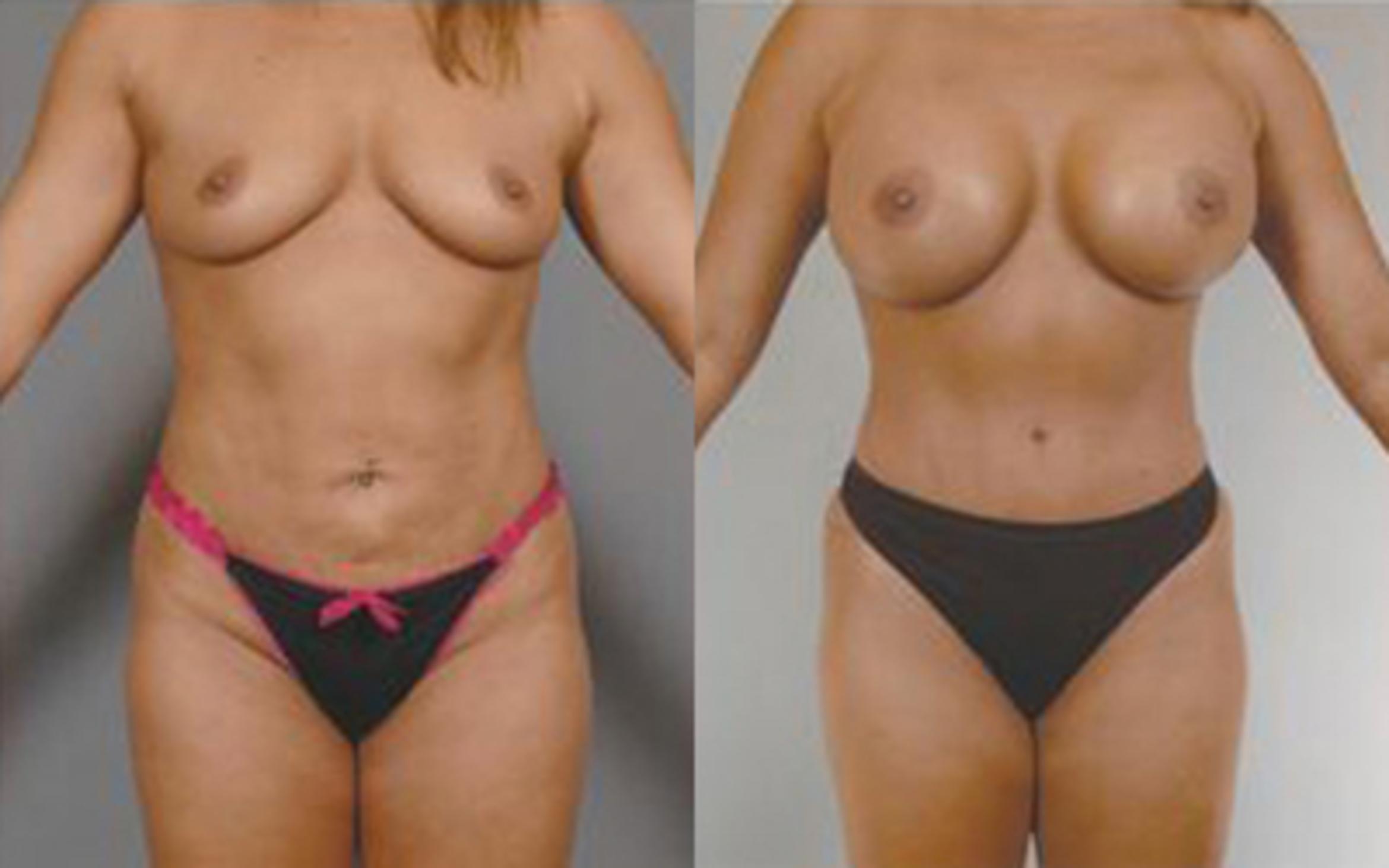 Before & After Tummy Tuck Case 70 View 1 View in Houston, TX