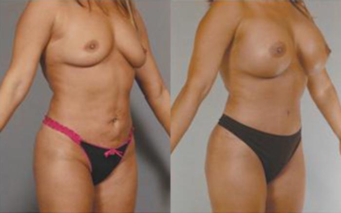 Before & After Tummy Tuck Case 70 View 2 View in Houston, TX