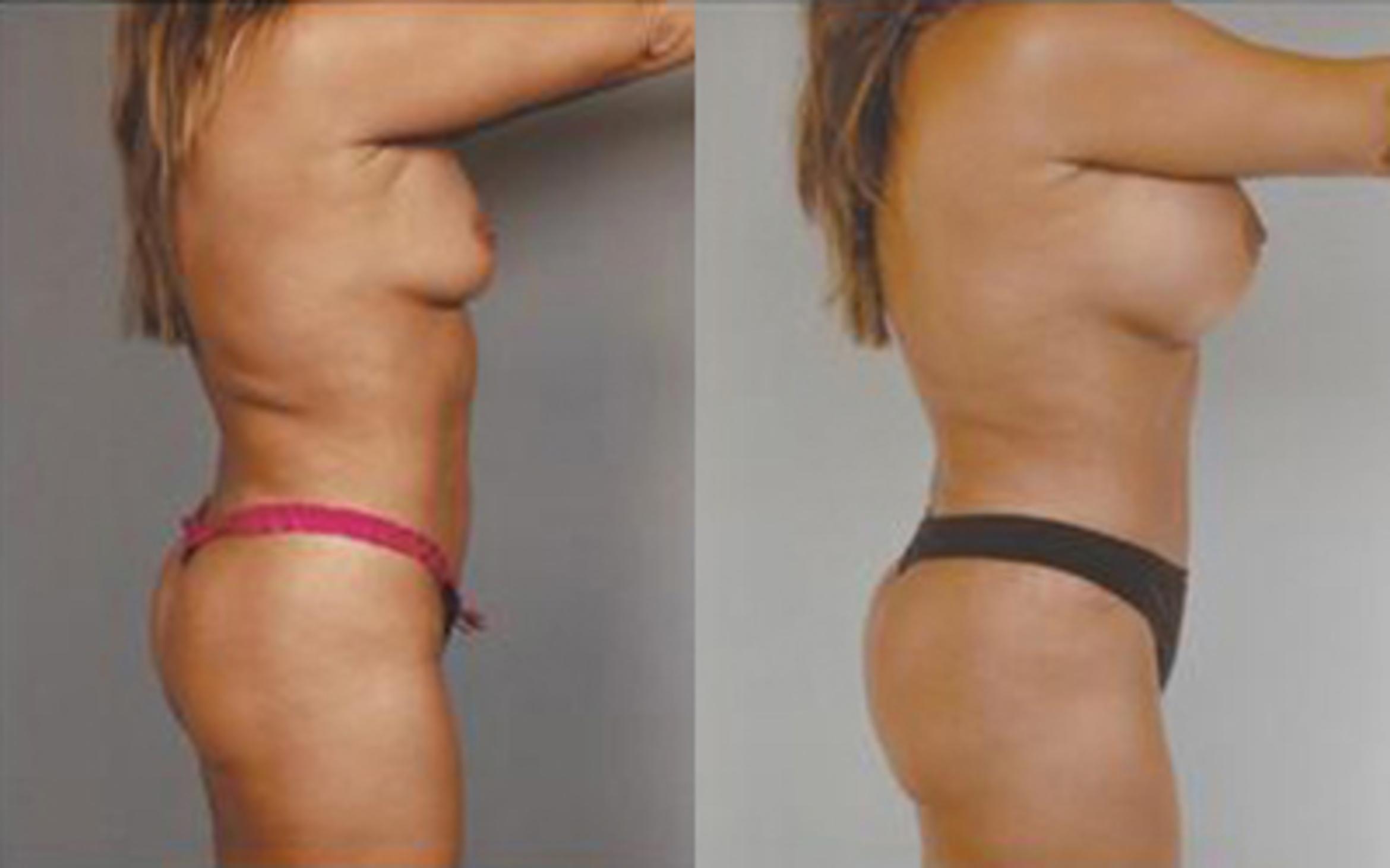 Before & After Tummy Tuck Case 70 View 3 View in Houston, TX
