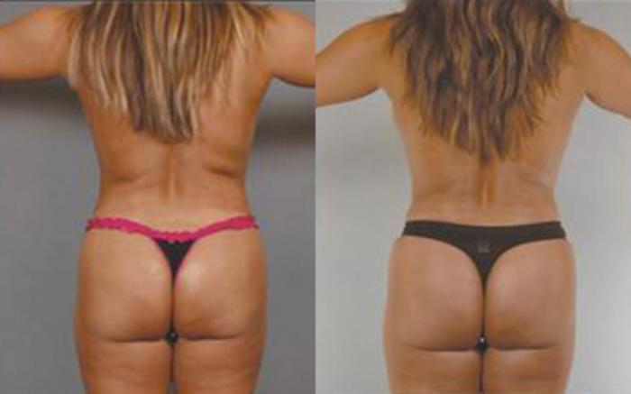 Before & After Tummy Tuck Case 70 View 4 View in Houston, TX