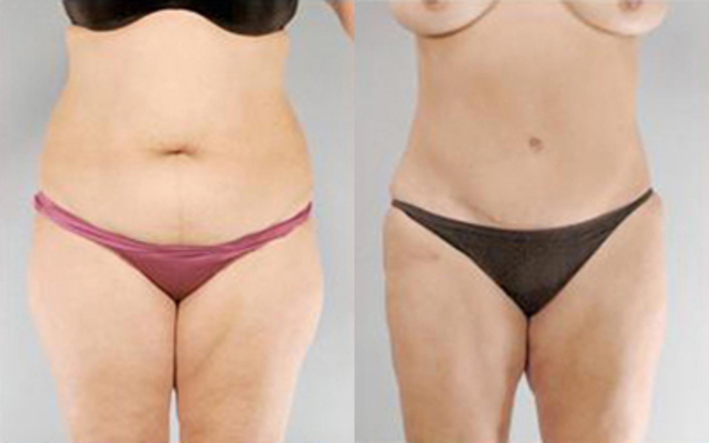 Before & After Tummy Tuck Case 71 View 1 View in Houston, TX