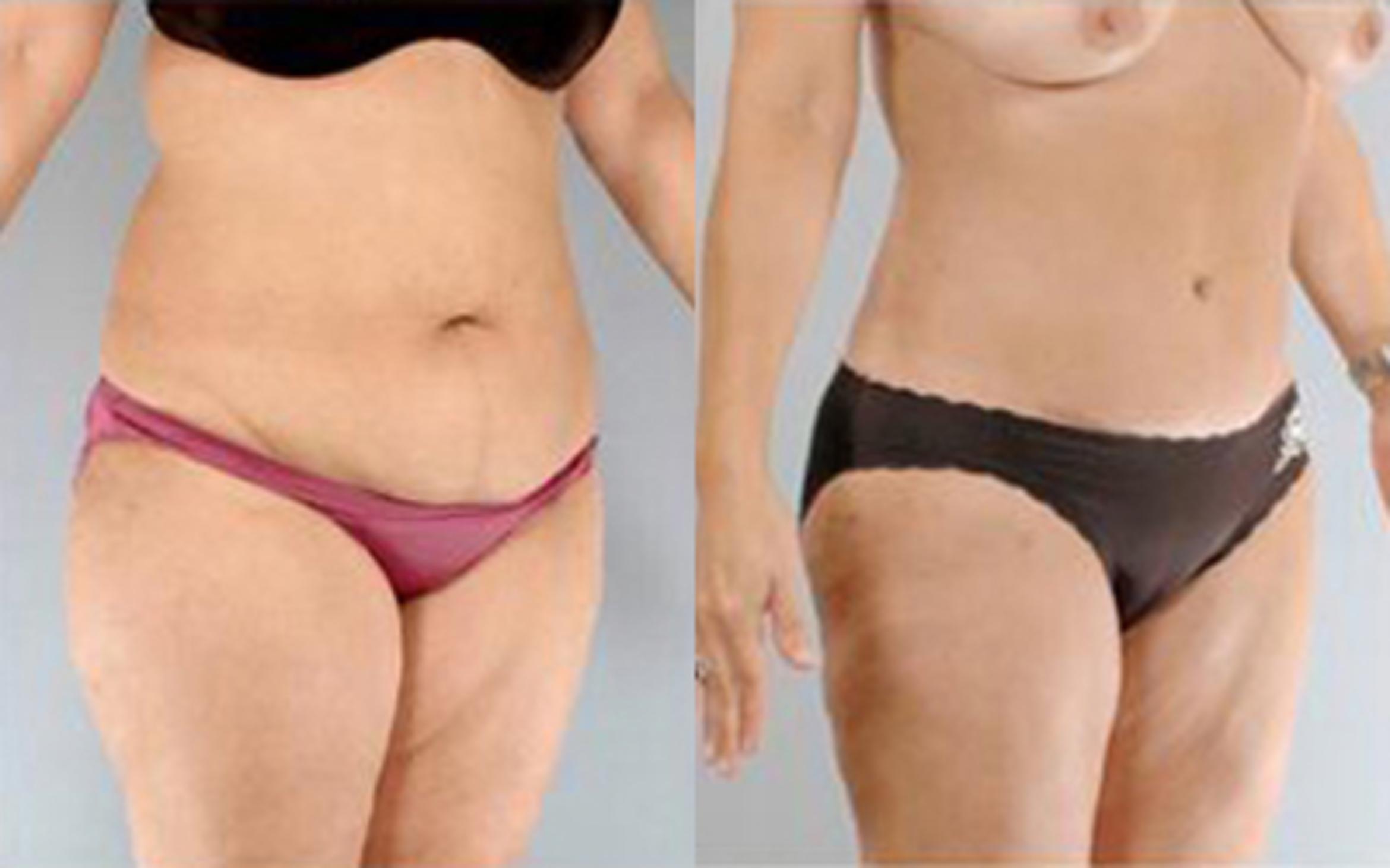 Before & After Tummy Tuck Case 71 View 2 View in Houston, TX