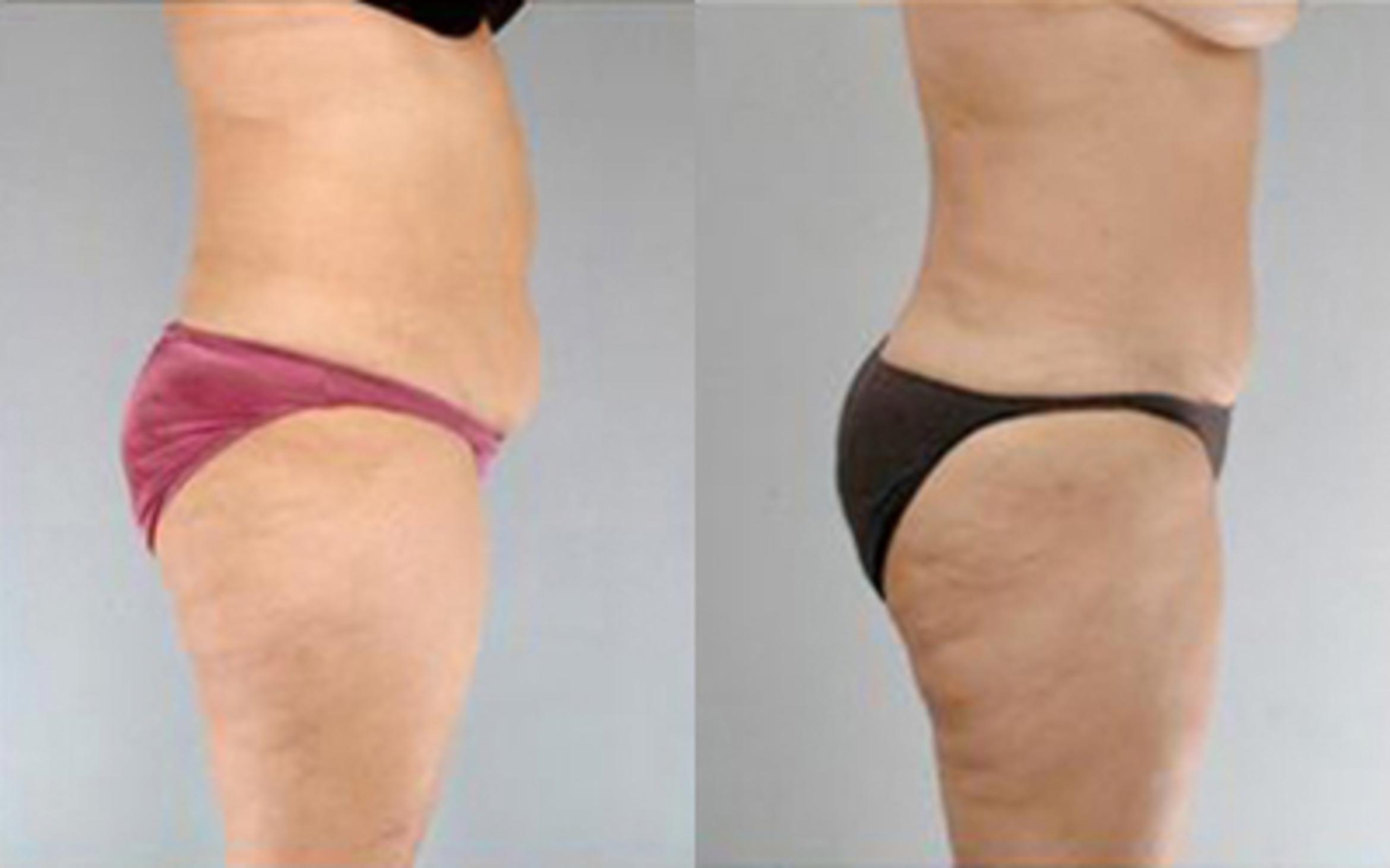 Before & After Tummy Tuck Case 71 View 3 View in Houston, TX