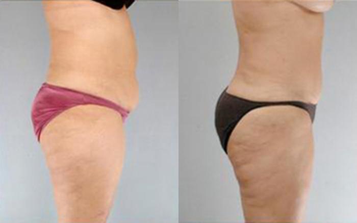 Before & After Tummy Tuck Case 71 View 3 View in Houston, TX