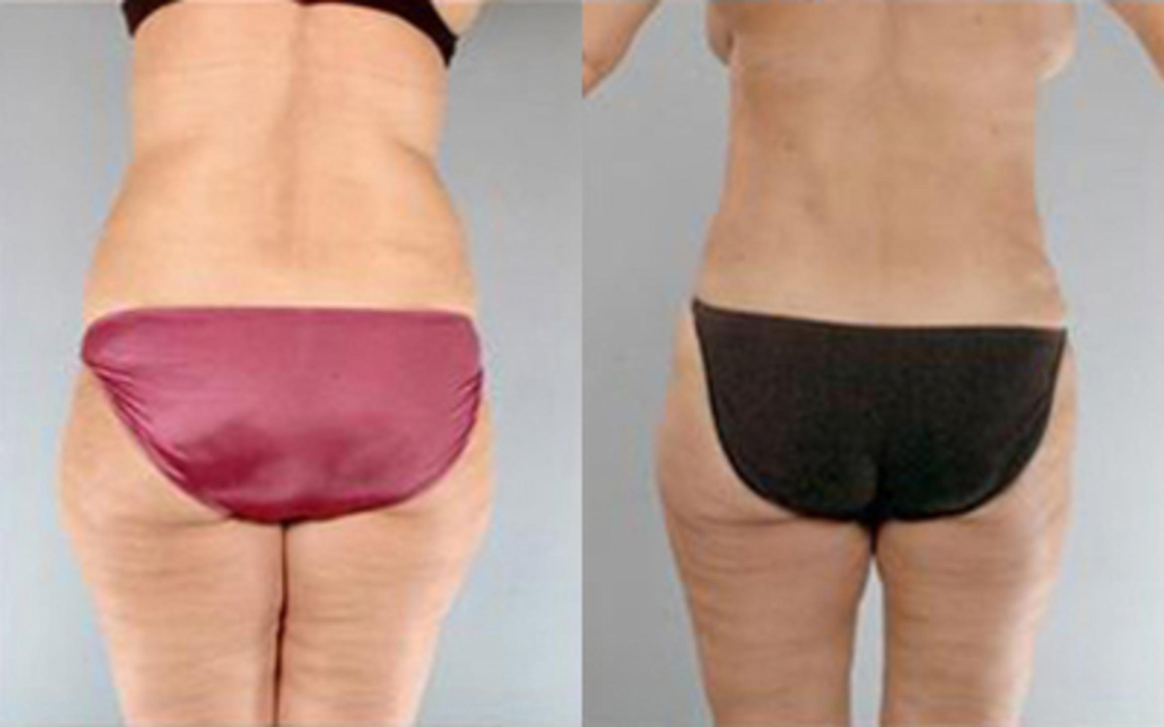 Before & After Tummy Tuck Case 71 View 4 View in Houston, TX