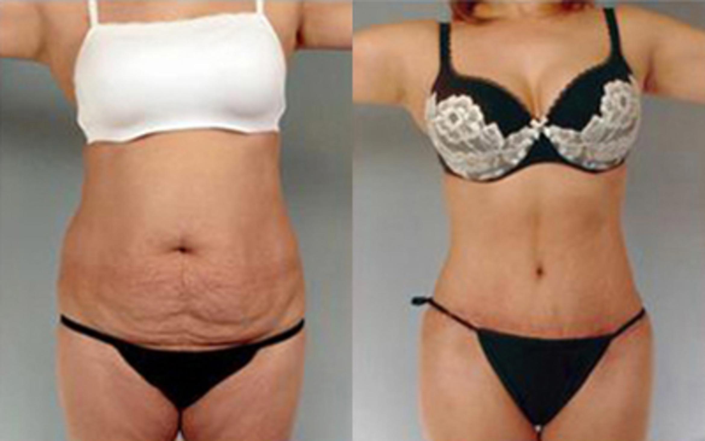 Before & After Tummy Tuck Case 72 View 1 View in Houston, TX