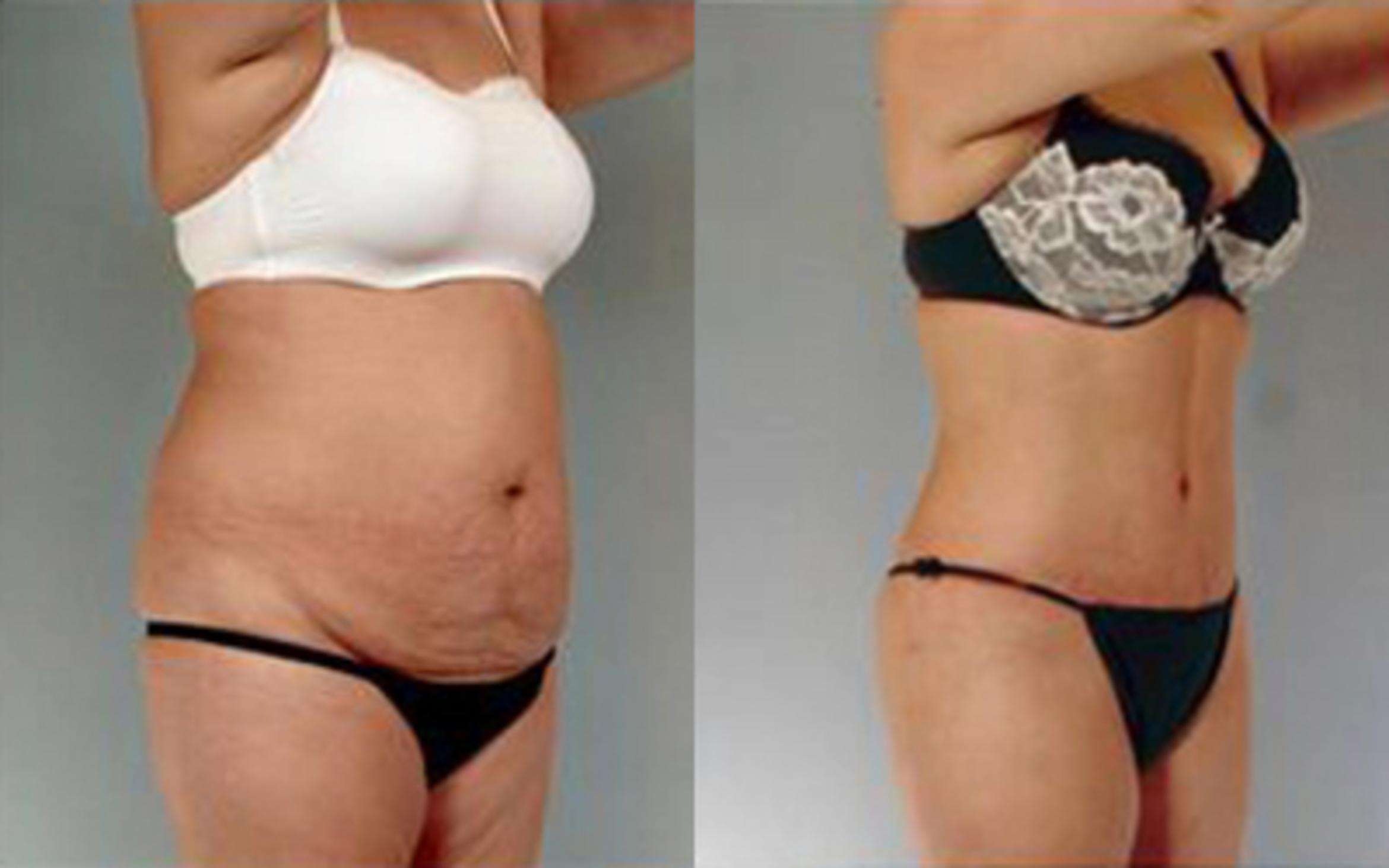 Before & After Tummy Tuck Case 72 View 2 View in Houston, TX