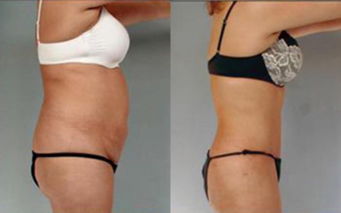 Before & After Tummy Tuck Case 72 View 3 View in Houston, TX