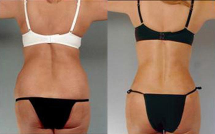Before & After Tummy Tuck Case 72 View 4 View in Houston, TX