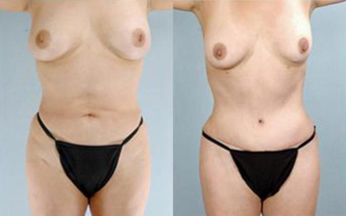 Before & After Tummy Tuck Case 73 View 1 View in Houston, TX
