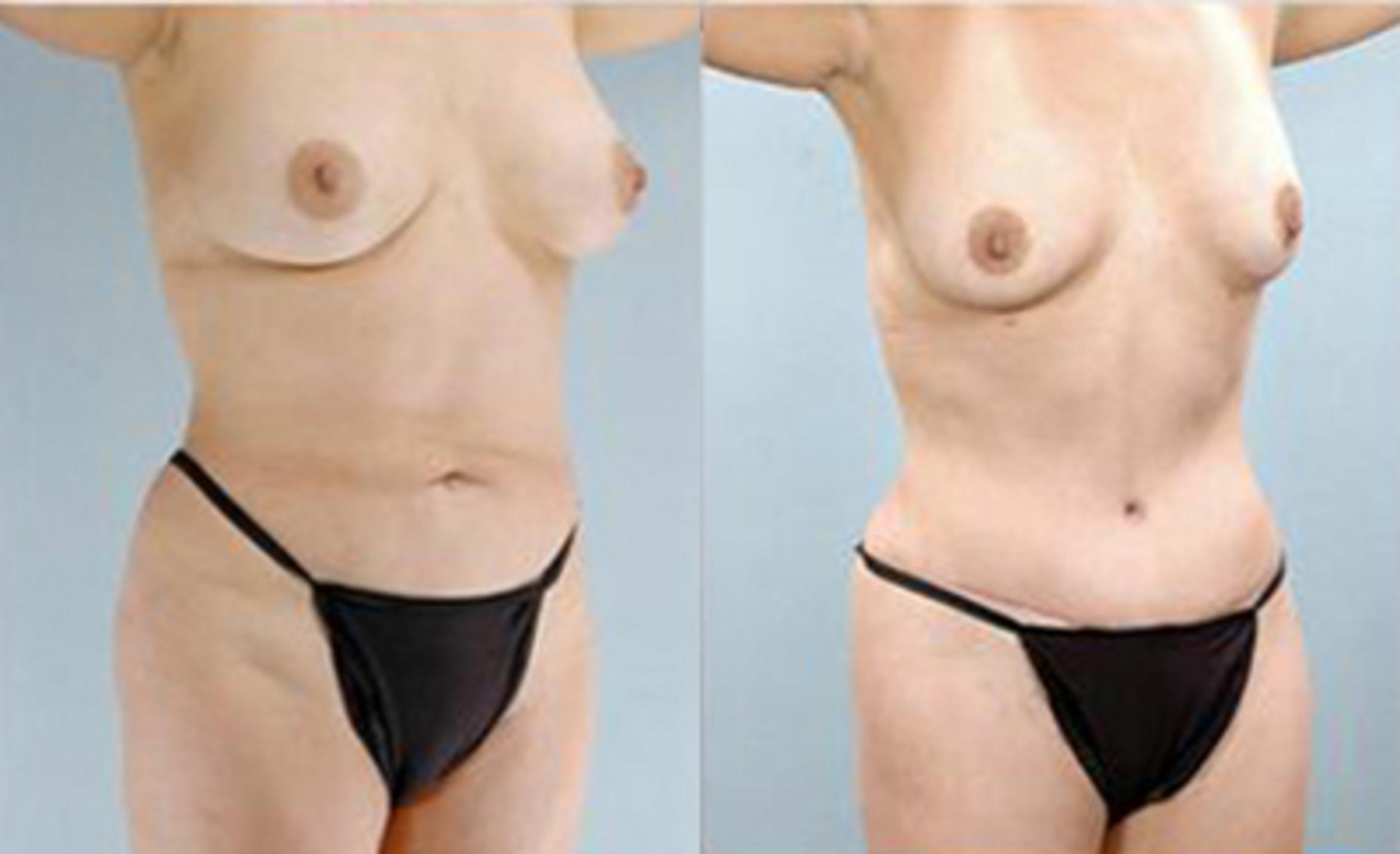 Before & After Tummy Tuck Case 73 View 2 View in Houston, TX