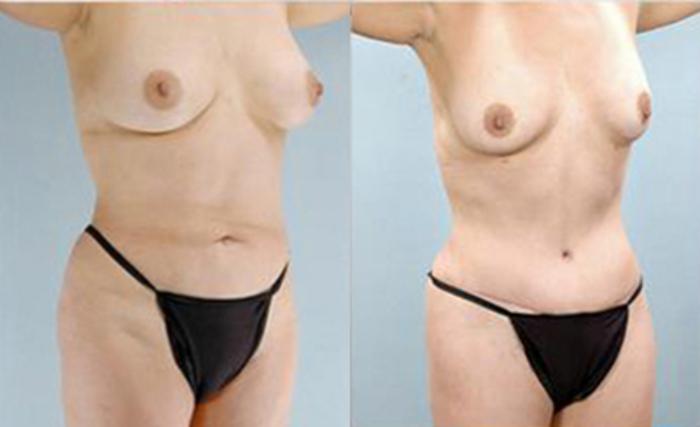 Before & After Tummy Tuck Case 73 View 2 View in Houston, TX