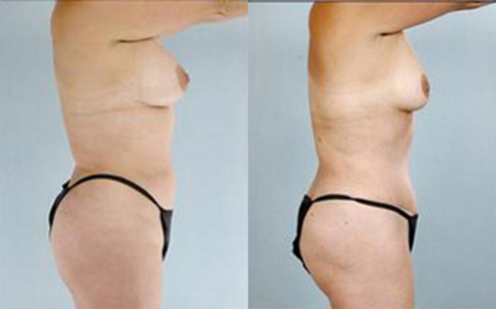 Before & After Tummy Tuck Case 73 View 3 View in Houston, TX