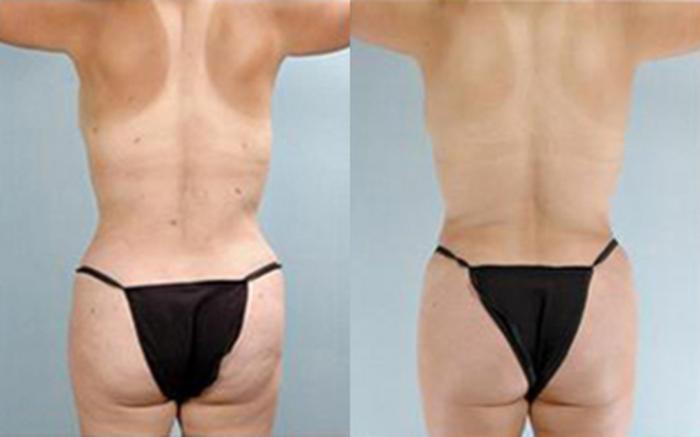 Before & After Tummy Tuck Case 73 View 4 View in Houston, TX