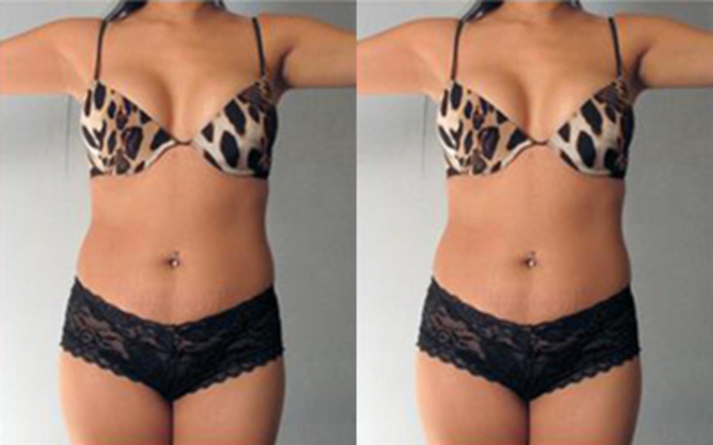 Before & After Tummy Tuck Case 74 View 1 View in Houston, TX
