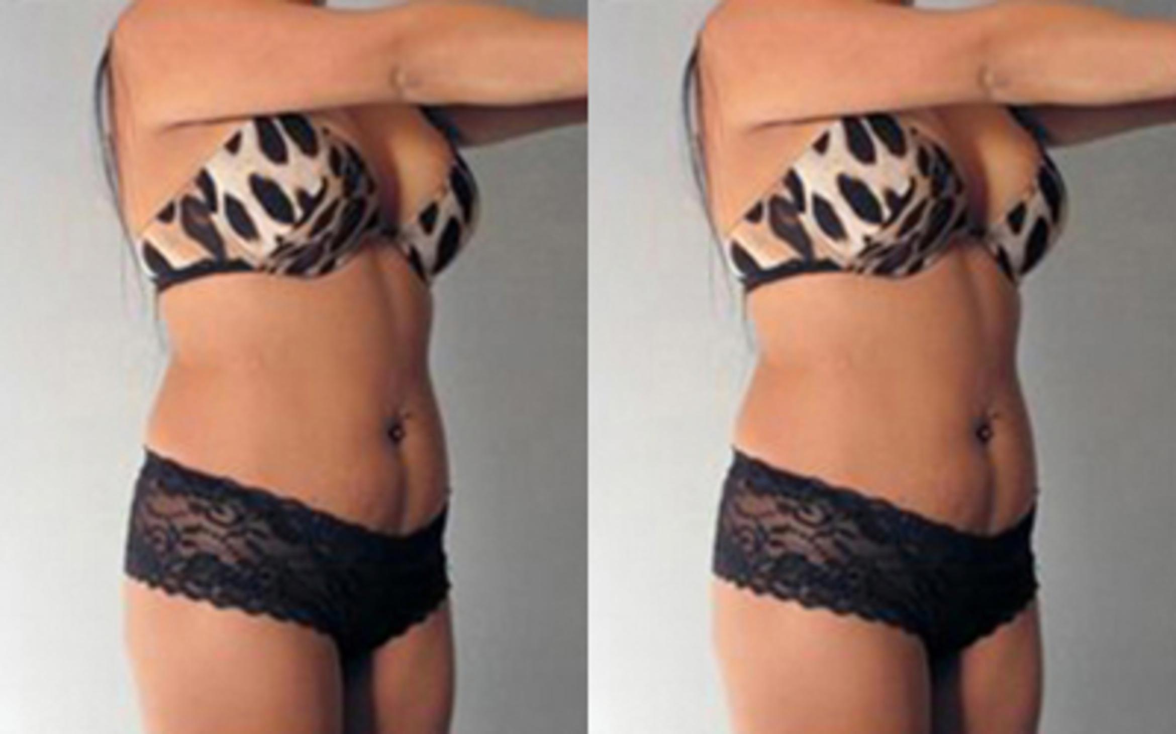 Before & After Tummy Tuck Case 74 View 2 View in Houston, TX