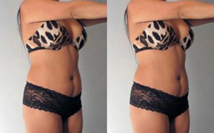 Before & After Tummy Tuck Case 74 View 2 View in Houston, TX