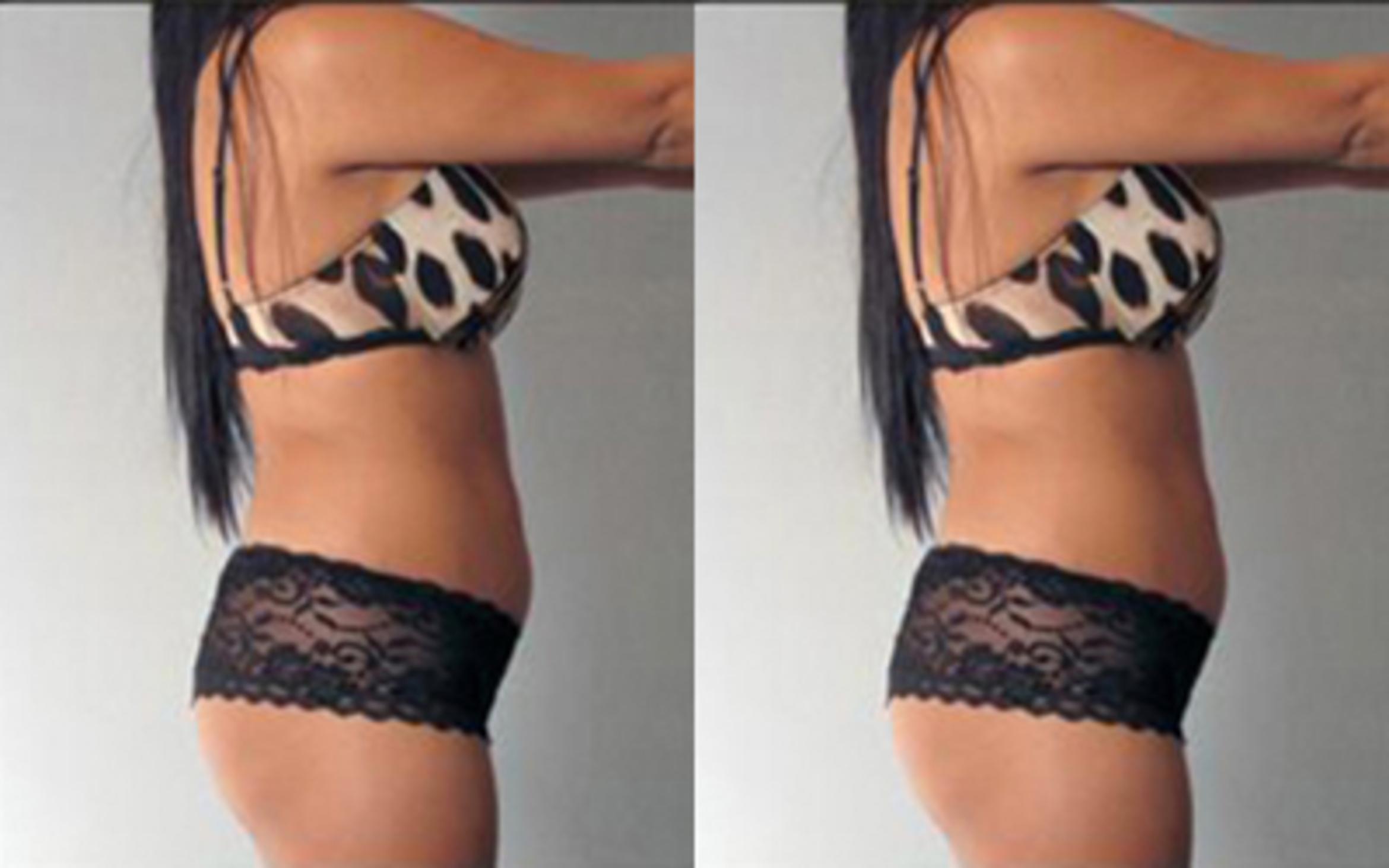 Before & After Tummy Tuck Case 74 View 3 View in Houston, TX