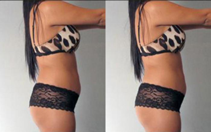 Before & After Tummy Tuck Case 74 View 3 View in Houston, TX