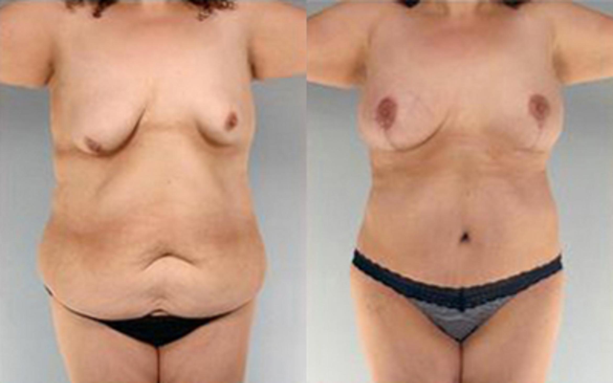 Before & After Tummy Tuck Case 75 View 1 View in Houston, TX