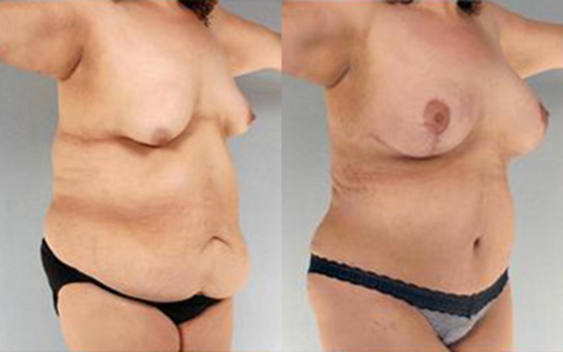 Before & After Tummy Tuck Case 75 View 2 View in Houston, TX