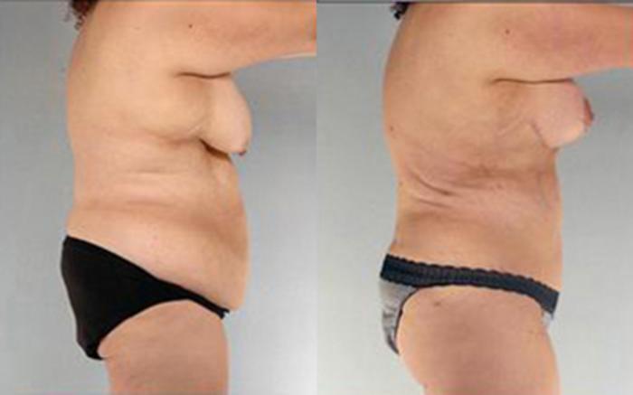 Before & After Tummy Tuck Case 75 View 3 View in Houston, TX