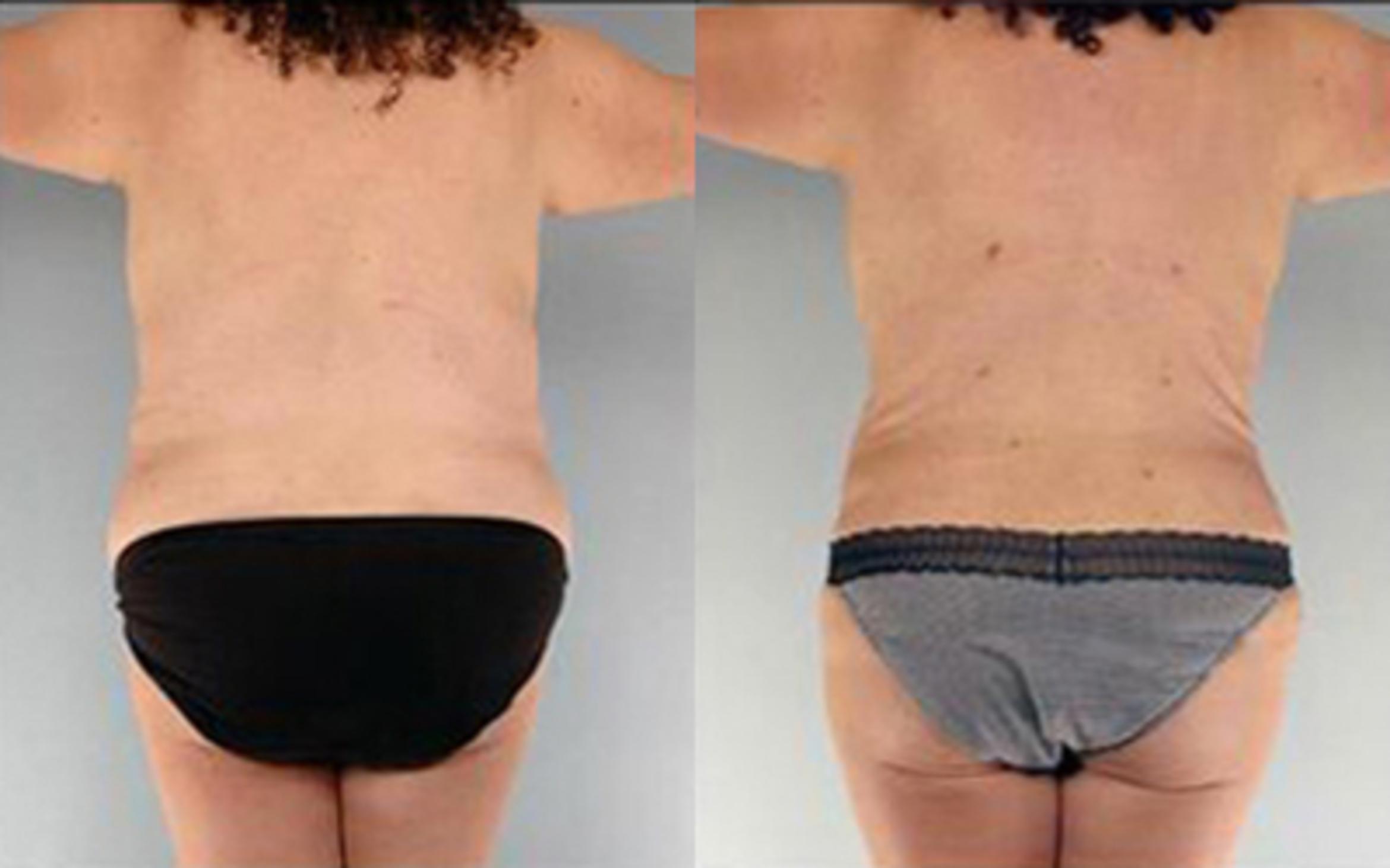 Before & After Tummy Tuck Case 75 View 4 View in Houston, TX