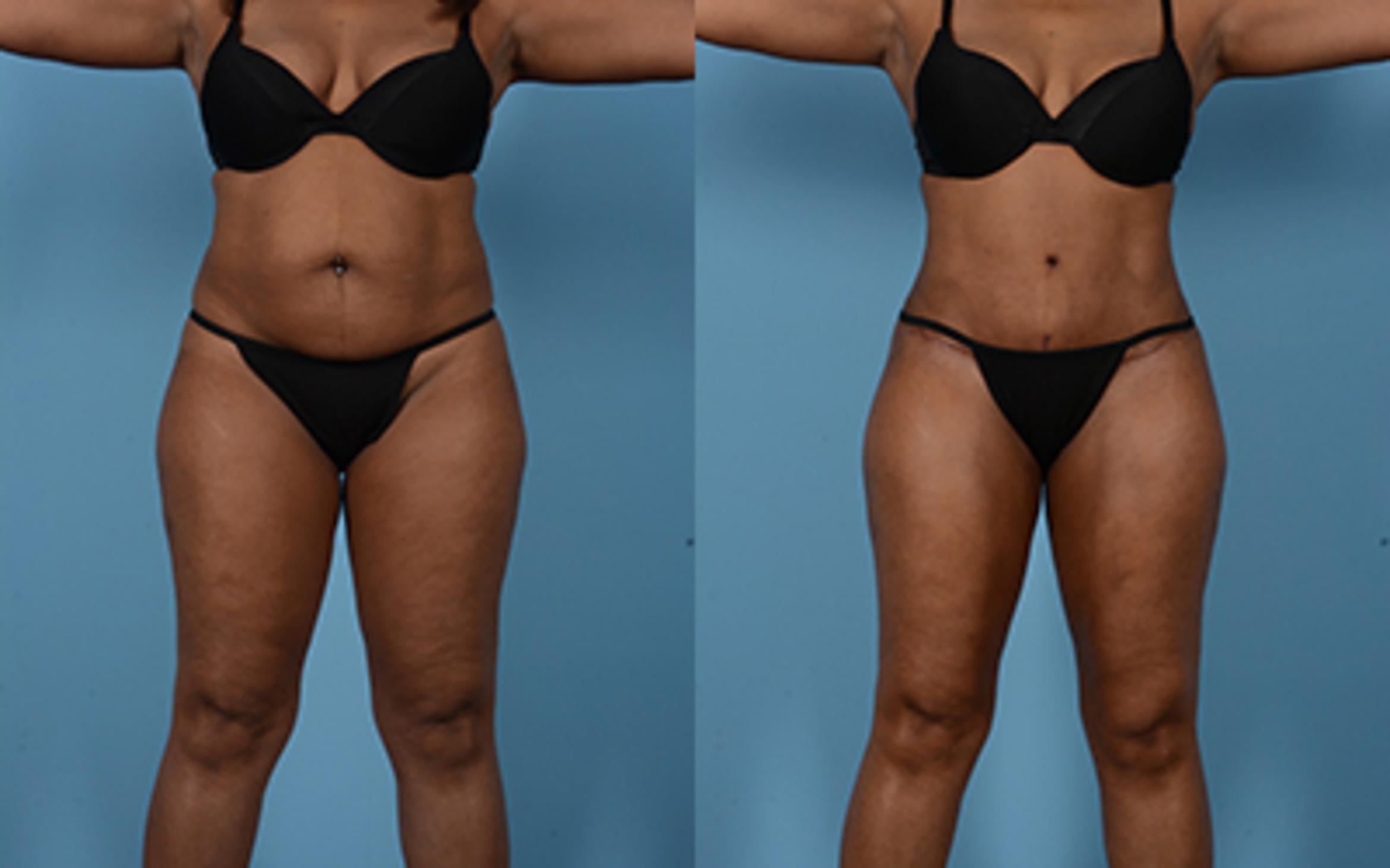 Before & After Tummy Tuck Case 75248 View 1 View in Houston, TX