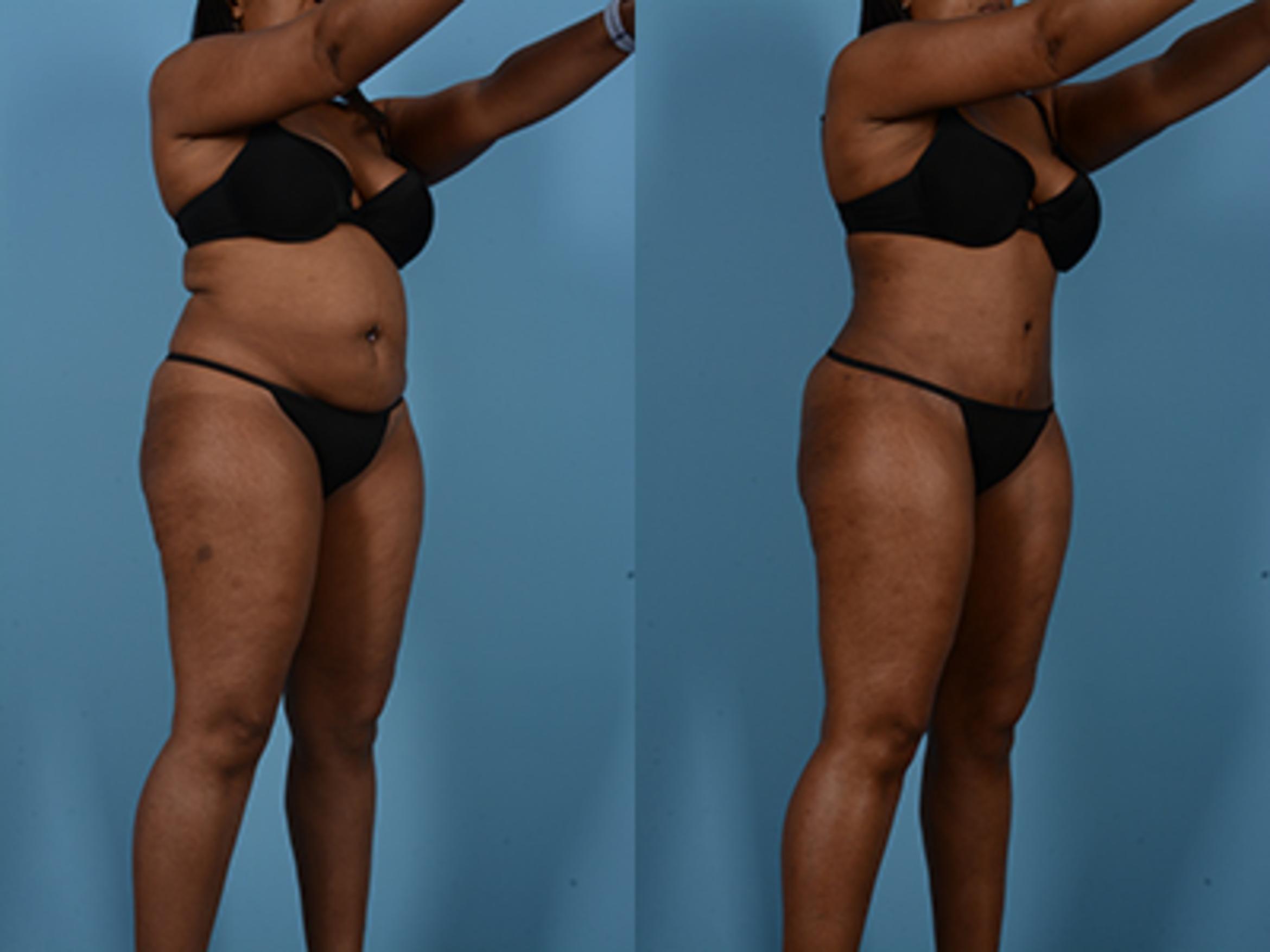 Before & After Tummy Tuck Case 75248 View 2 View in Houston, TX