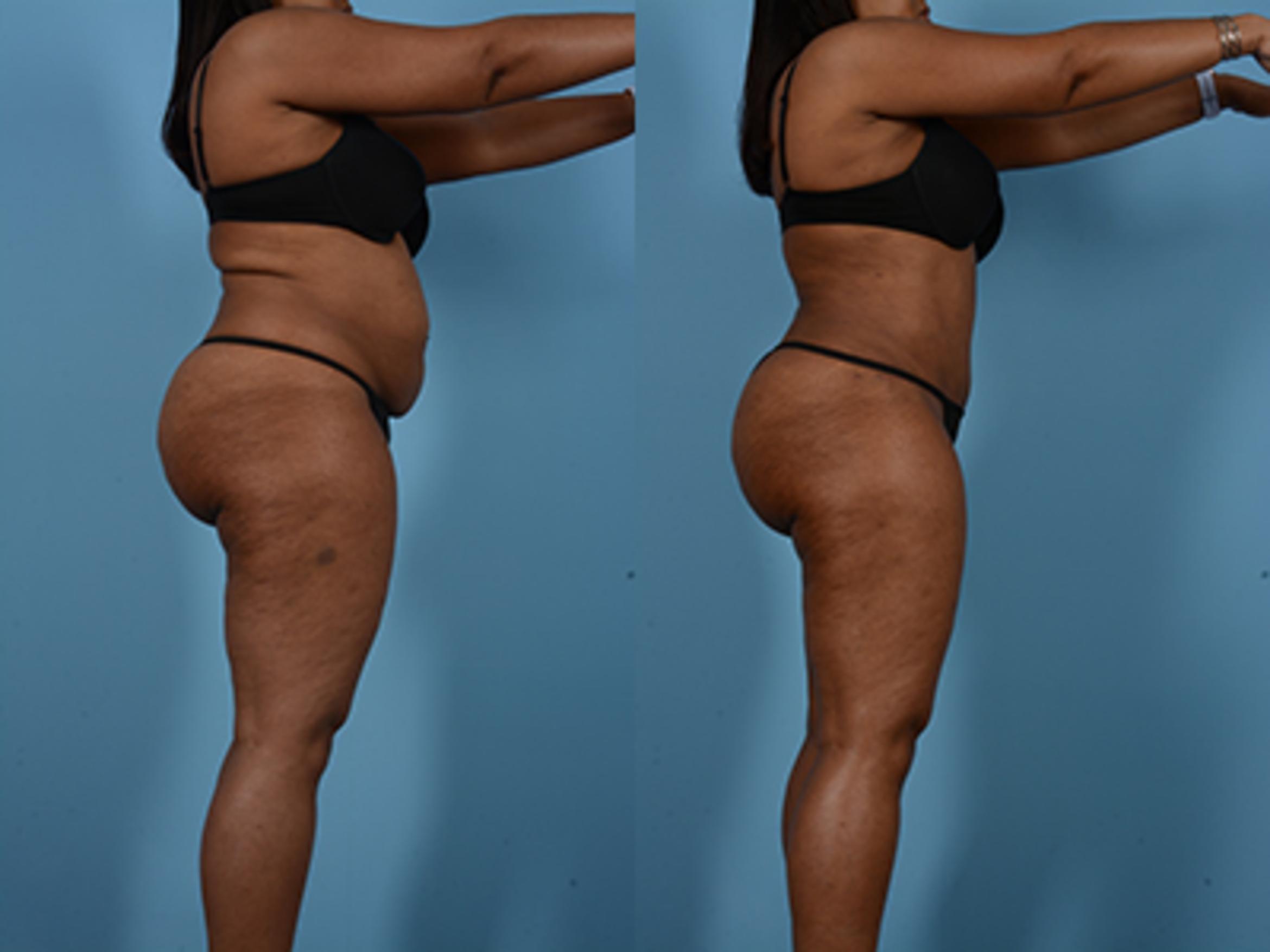 Before & After Tummy Tuck Case 75248 View 3 View in Houston, TX