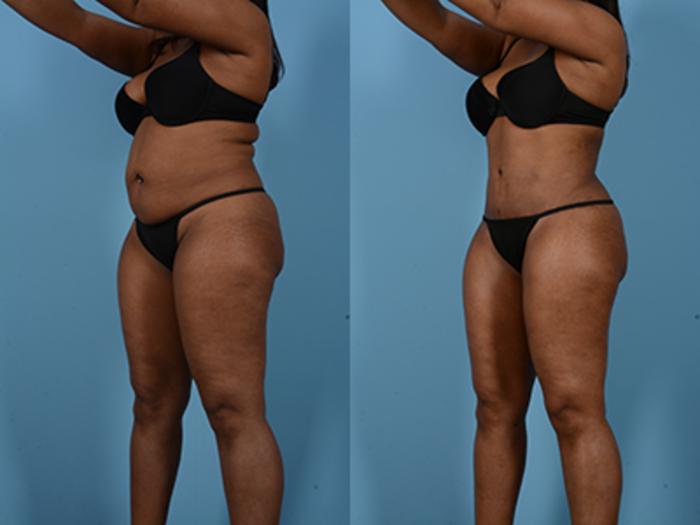 Before & After Tummy Tuck Case 75248 View 4 View in Houston, TX