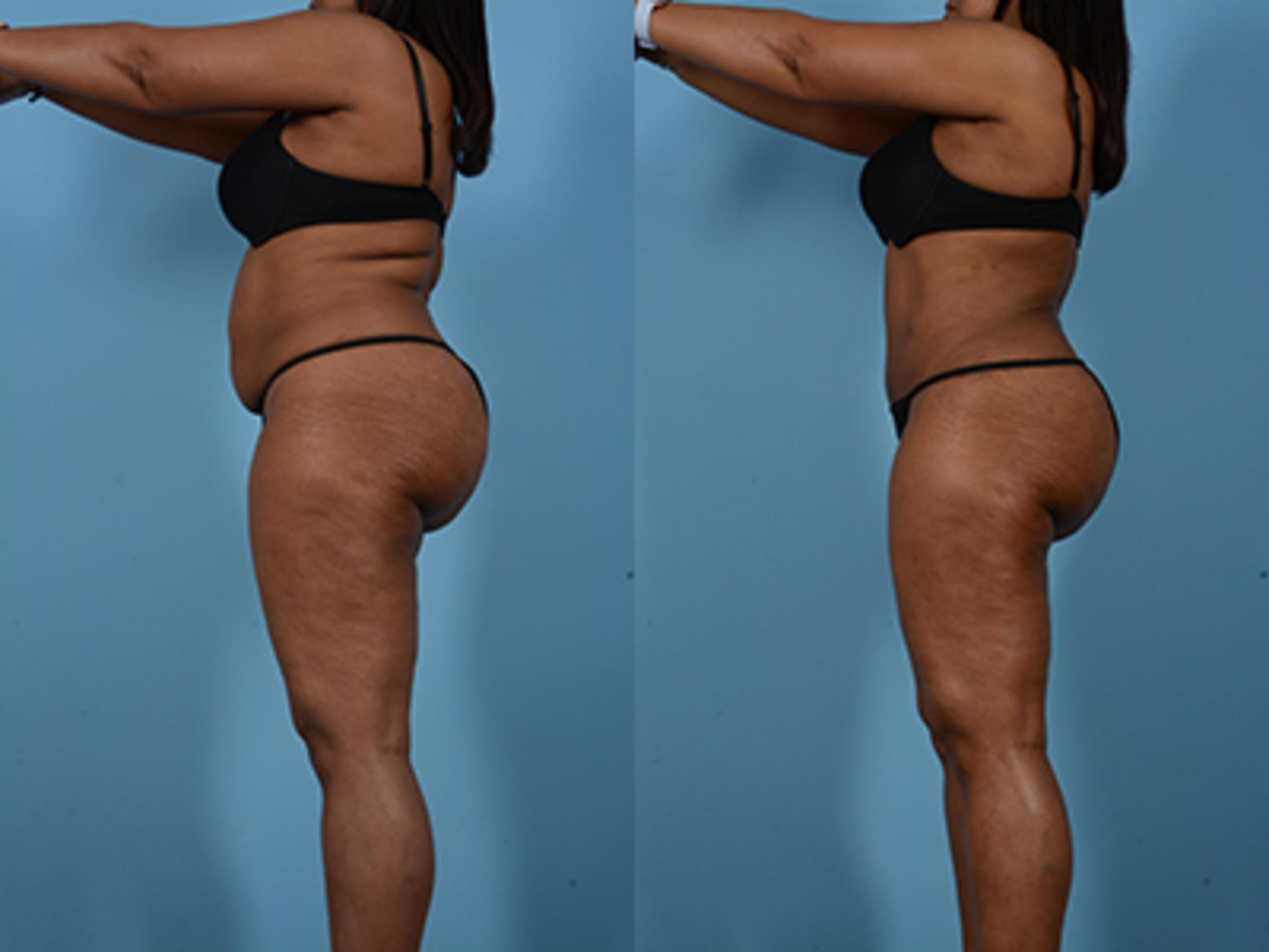 Before & After Tummy Tuck Case 75248 View 5 View in Houston, TX