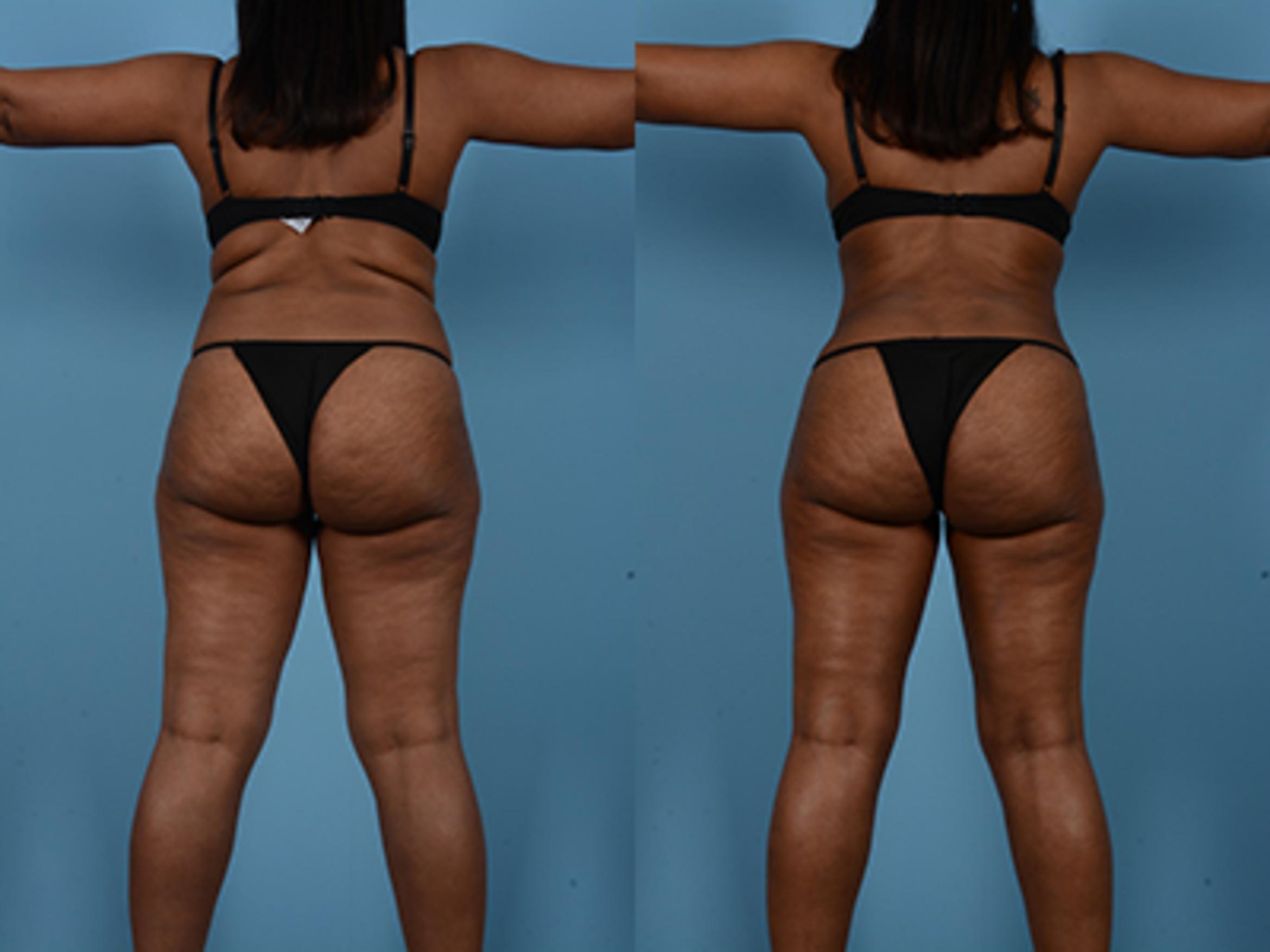 Before & After Tummy Tuck Case 75248 View 6 View in Houston, TX