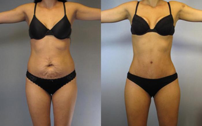 Before & After Tummy Tuck Case 7608 View 1 View in Houston, TX