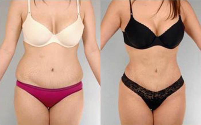 Before & After Tummy Tuck Case 77 View 1 View in Houston, TX