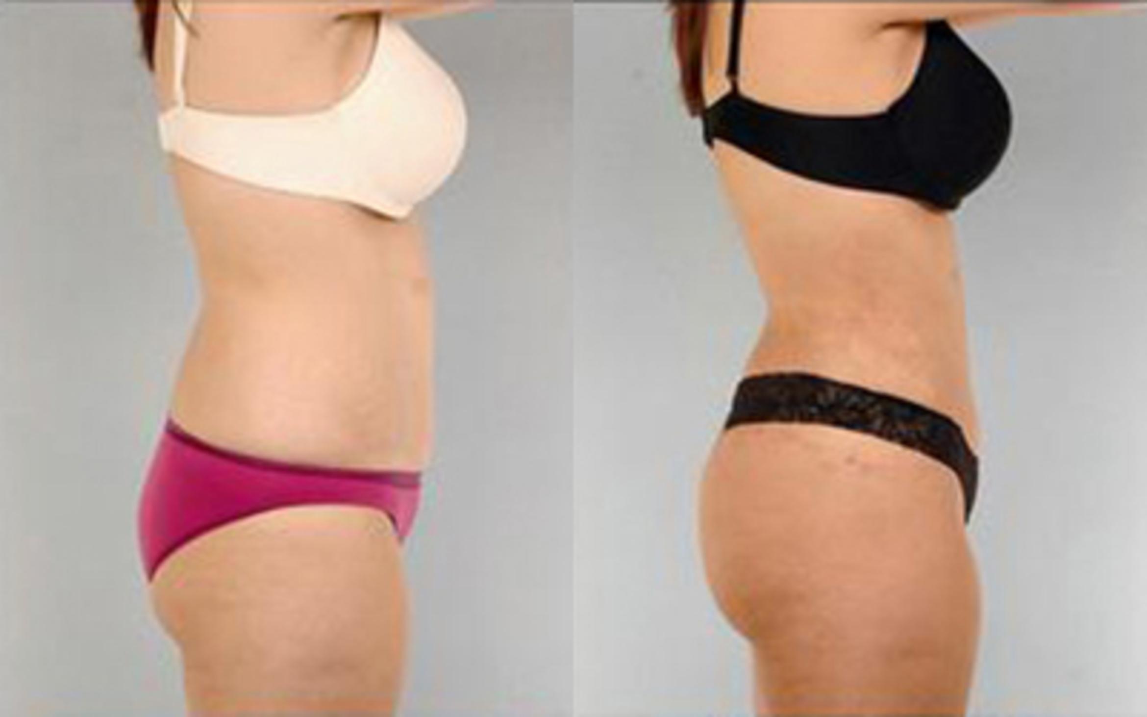 Before & After Tummy Tuck Case 77 View 3 View in Houston, TX