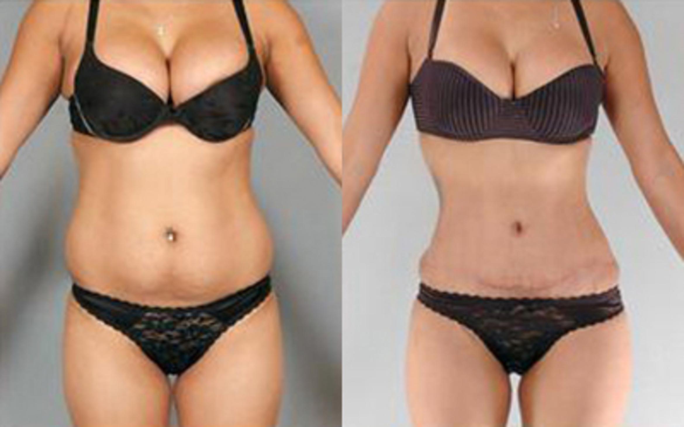 Before & After Tummy Tuck Case 78 View 1 View in Houston, TX