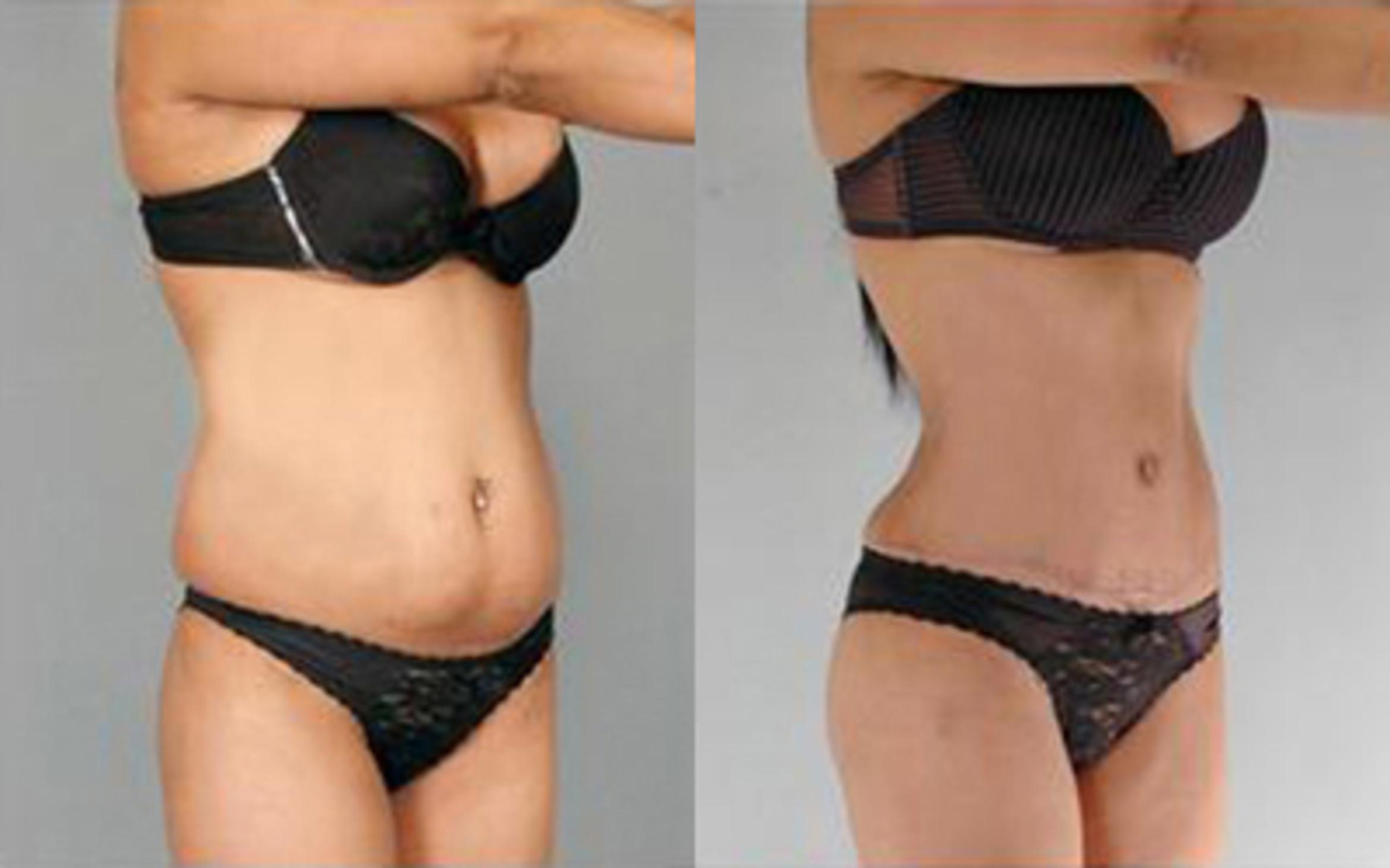 Before & After Tummy Tuck Case 78 View 2 View in Houston, TX