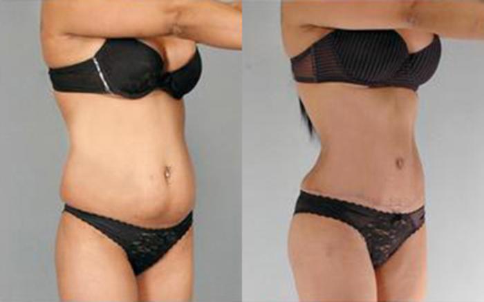 Before & After Tummy Tuck Case 78 View 2 View in Houston, TX