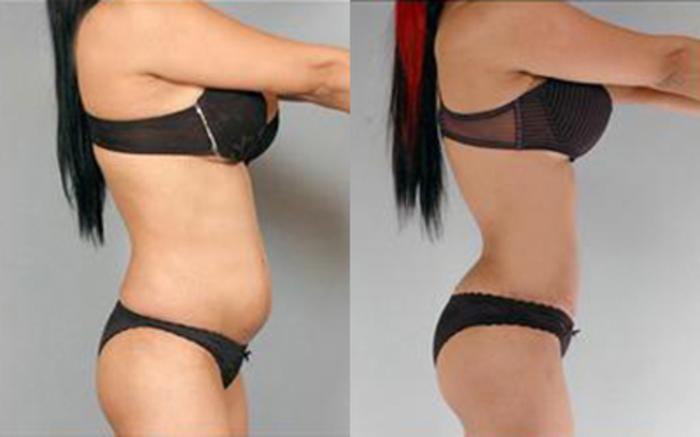 Before & After Tummy Tuck Case 78 View 3 View in Houston, TX