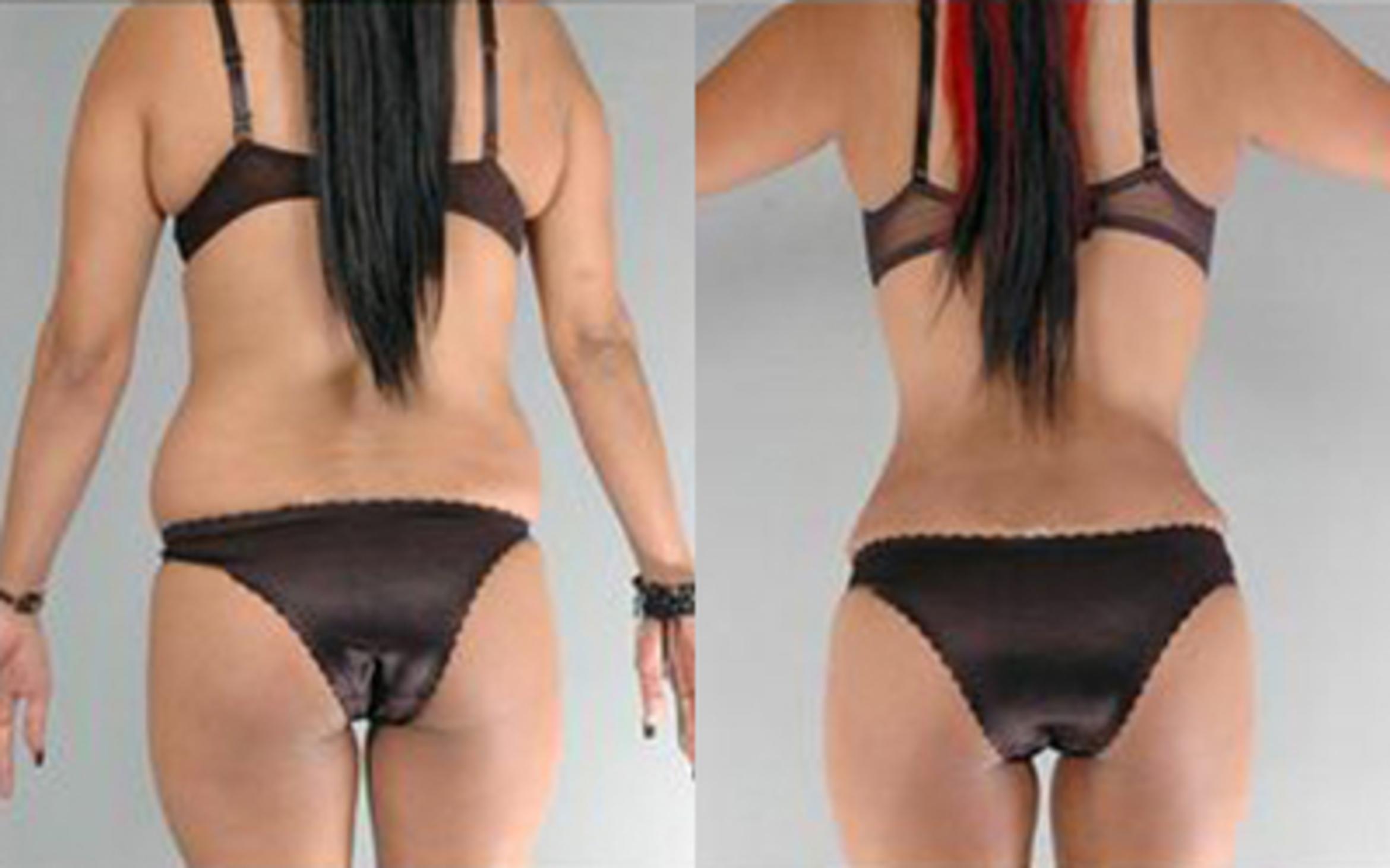 Before & After Tummy Tuck Case 78 View 4 View in Houston, TX