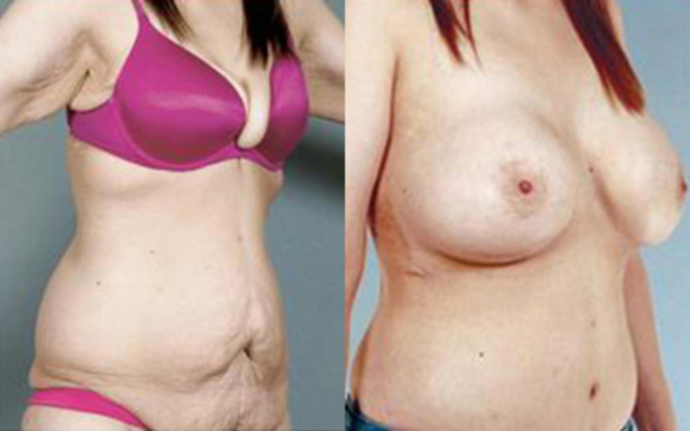Before & After Tummy Tuck Case 79 View 2 View in Houston, TX