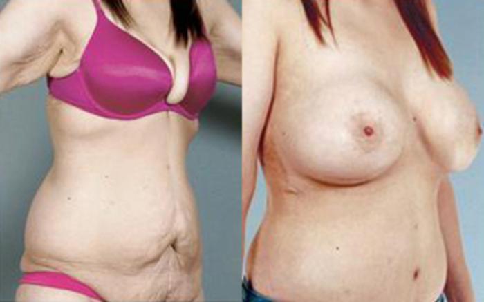 Before & After Tummy Tuck Case 79 View 2 View in Houston, TX