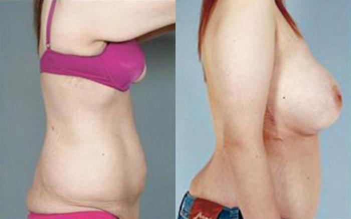 Before & After Tummy Tuck Case 79 View 3 View in Houston, TX