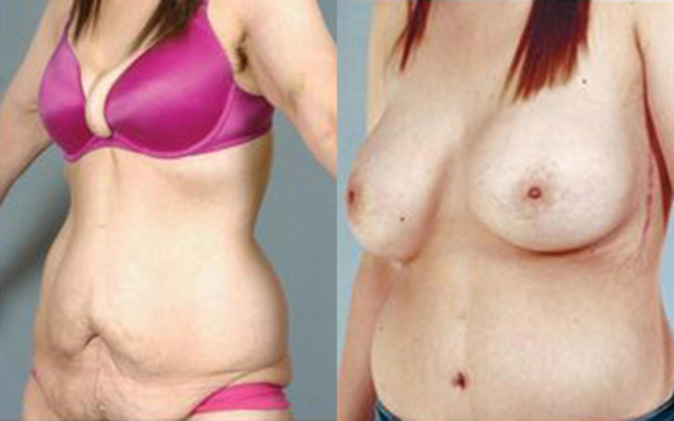 Before & After Tummy Tuck Case 79 View 4 View in Houston, TX