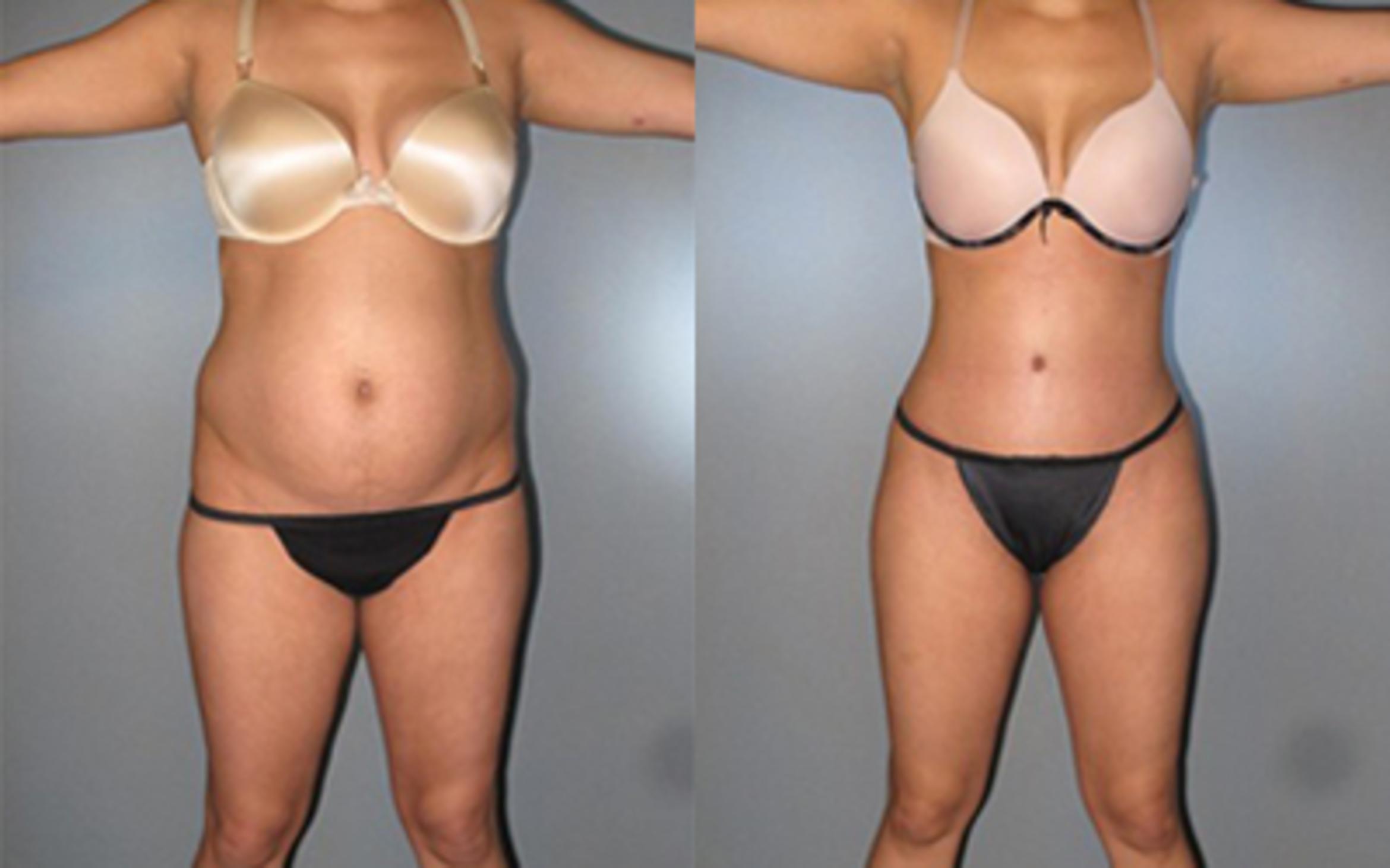 Before & After Tummy Tuck Case 7974 View 1 View in Houston, TX