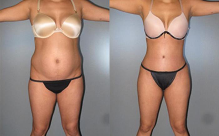 Before & After Tummy Tuck Case 7974 View 1 View in Houston, TX