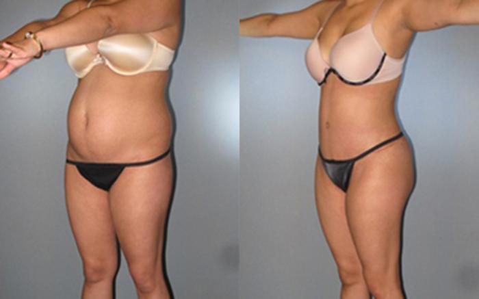 Before & After Tummy Tuck Case 7974 View 2 View in Houston, TX